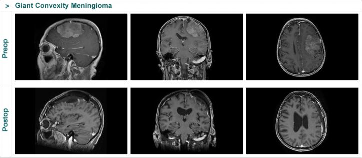Giant Convexity Meningioma