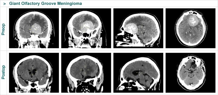 Giant Olfactory Groove Meningioma