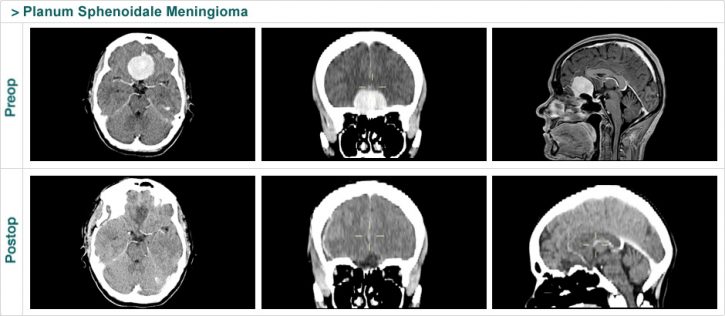 Planum Sphenoidale Meningioma