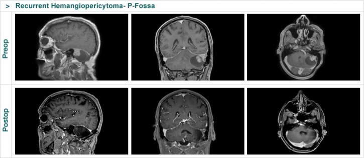 Recurrent Hemangiopericytoma- P-Fossa