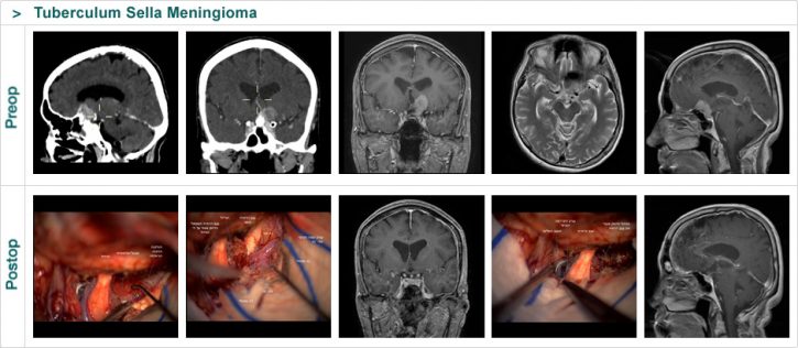 Tuberculum Sella Meningioma