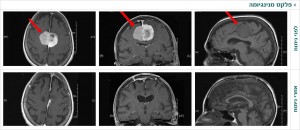 פלקס מנינגיומה