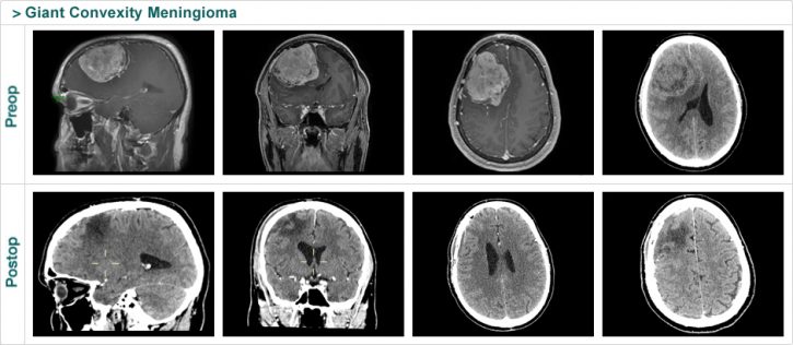 Giant Convexity Meningioma