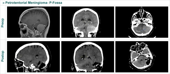 Petrotentorial Meningioma- P-Fossa