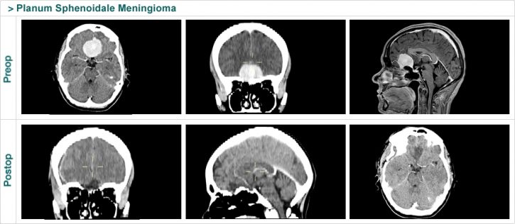 Planum Sphenoidale Meningioma