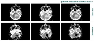 ניקוז המטומה טראומטית מהמוחון