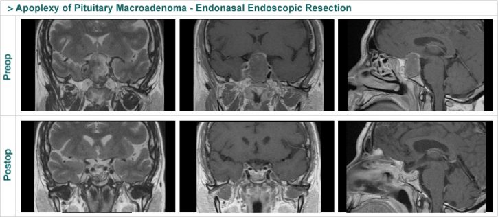 Apoplexy of Pituitary Macroadenoma - Endonasal Endoscopic Resection