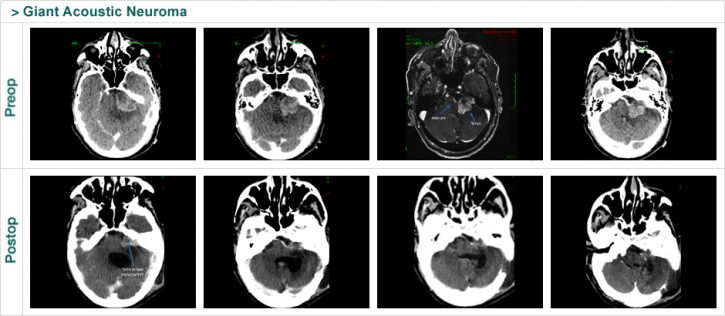 Giant Acoustic Neuroma