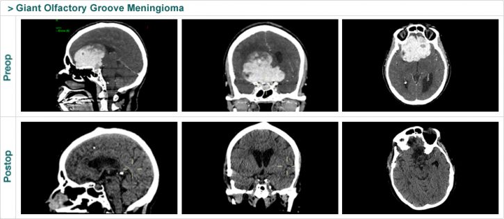 Giant Olfactory Groove Meningioma