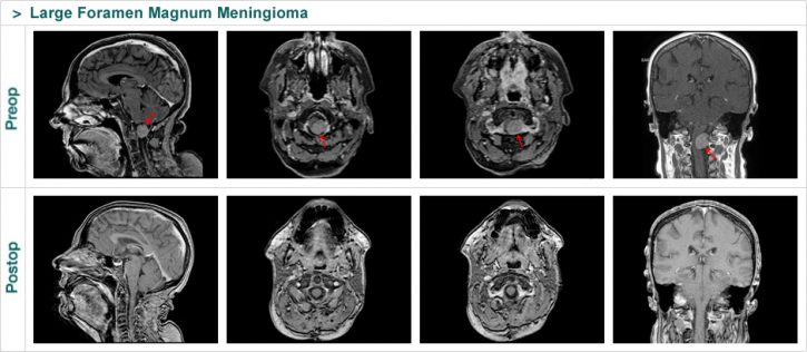 Large Foramen Magnum Meningioma
